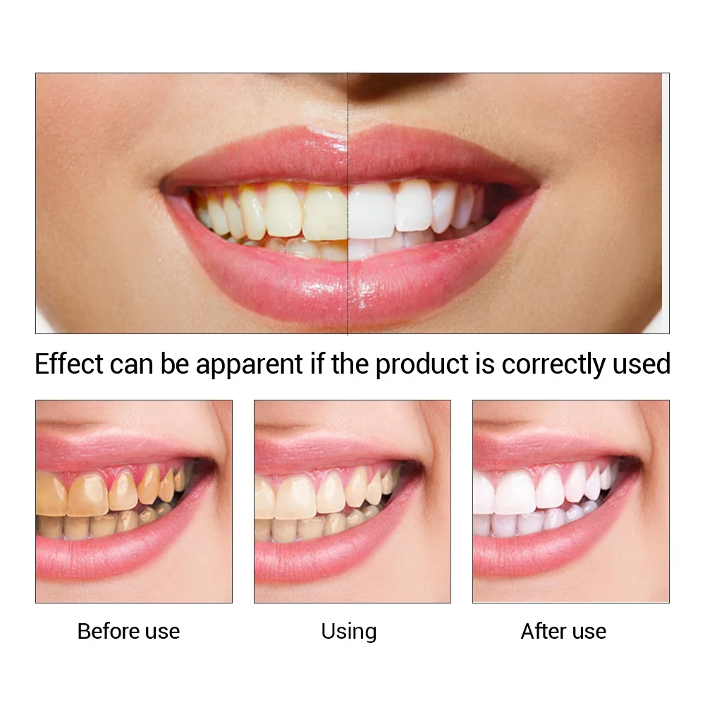 FTEENPLY Teeth Whitening Essen - Teeth Whitening Street review and price
