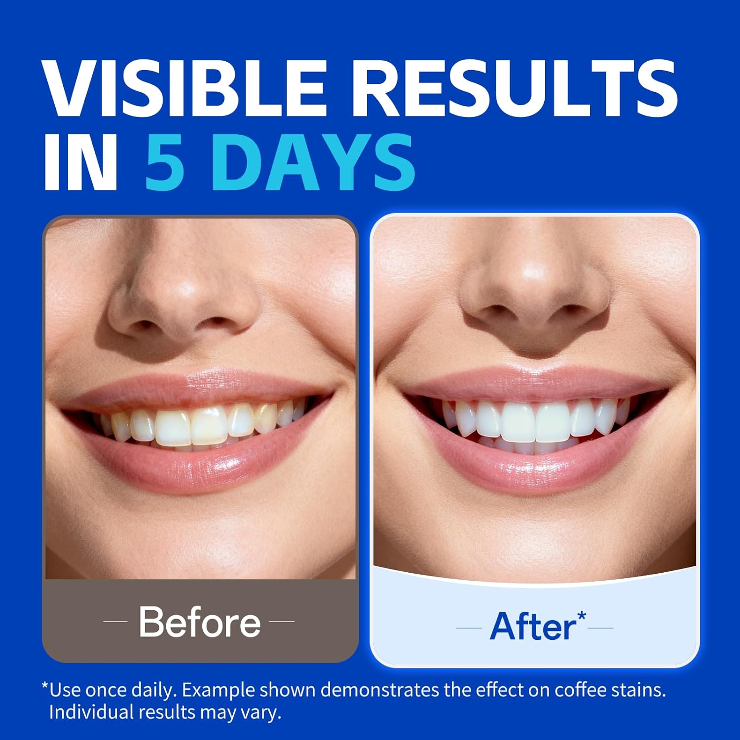 1/7 Pairs Teeth Whitening Stri - Teeth Whitening Street review and price