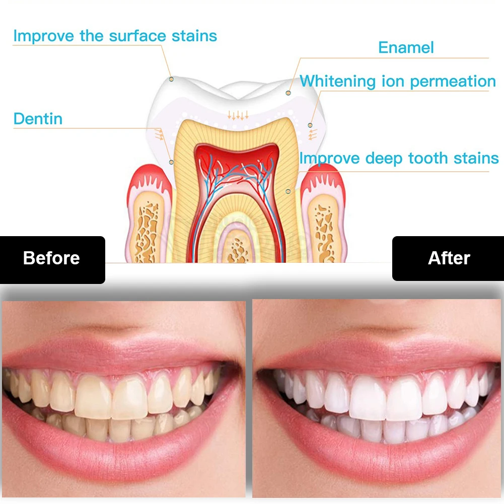 Dental Teeth Whitening Kit Min - Teeth Whitening Gel Pen review and price
